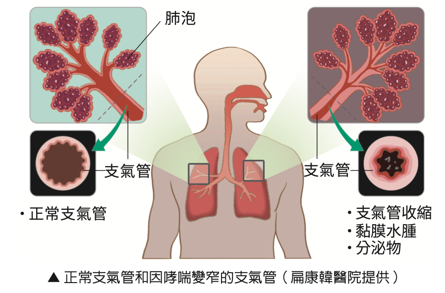 能治好哮喘嗎